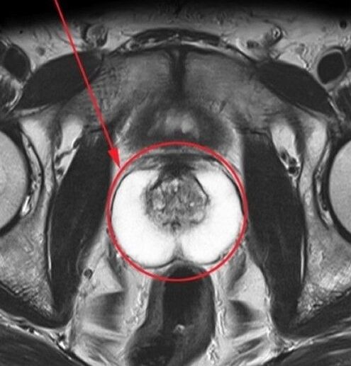 Prostata sana per gli ultrasuoni dopo aver preso ZxcvbnmqWert
