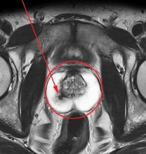 Prostatite ad ultrasuoni prima di prendere Zxcvbnmqwert