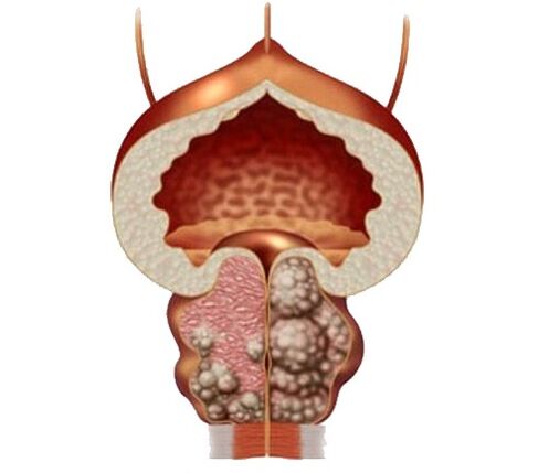 adenoma ed edema della prostata e trattamento con capsule Uosaf
