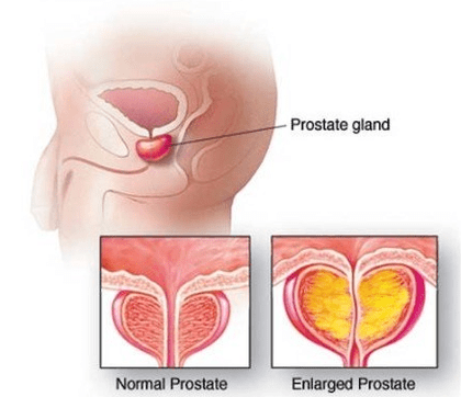 Prostata normale e infiammata