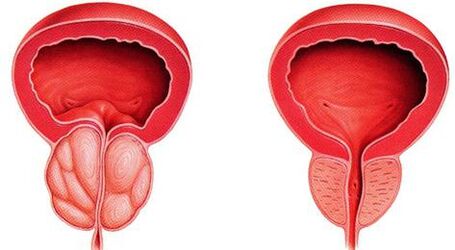 La differenza di prostata malata e sana