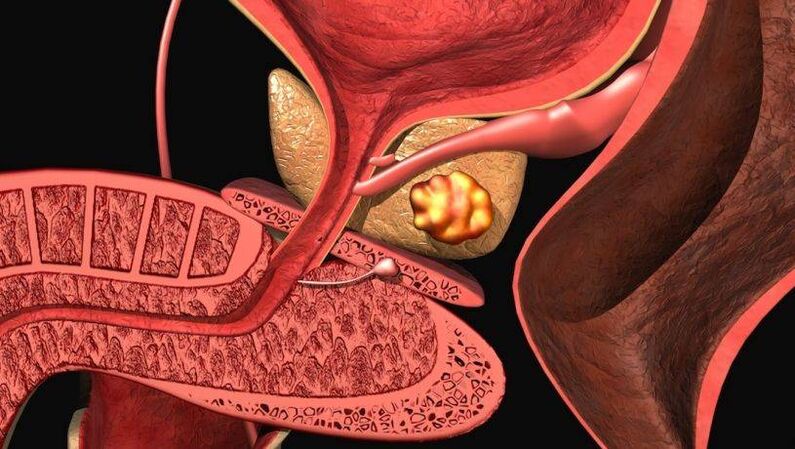 Infiammazione batterica della prostata